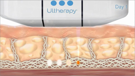 ultherapy